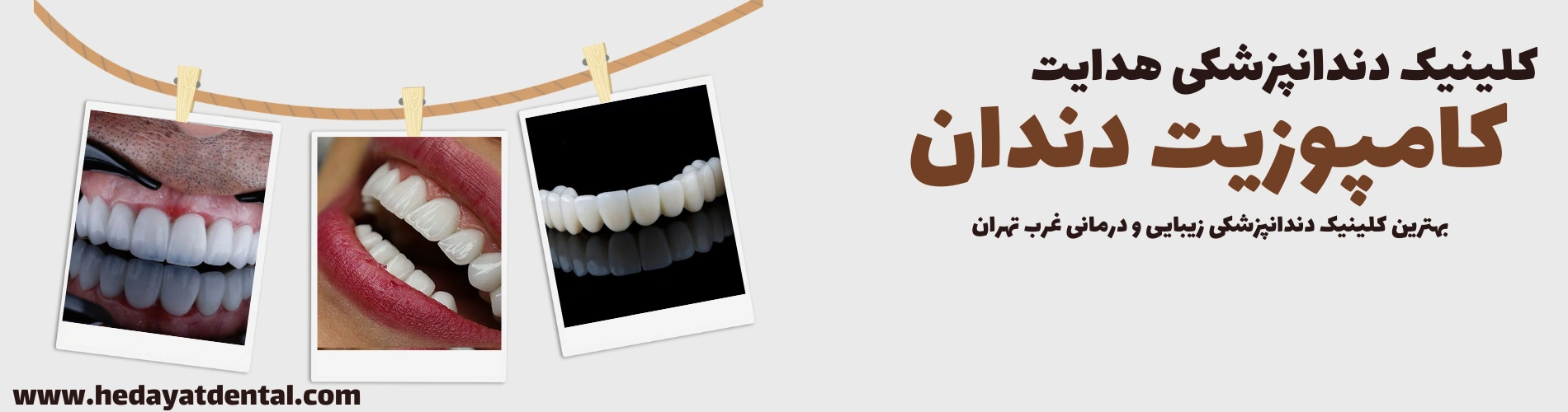 کامپوزیت دندان