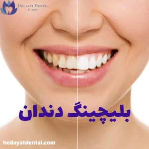 بلیچینگ دندان