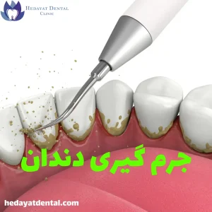 جرم‌گیری دندان