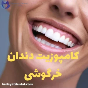 کامپوزیت دندان خرگوشی