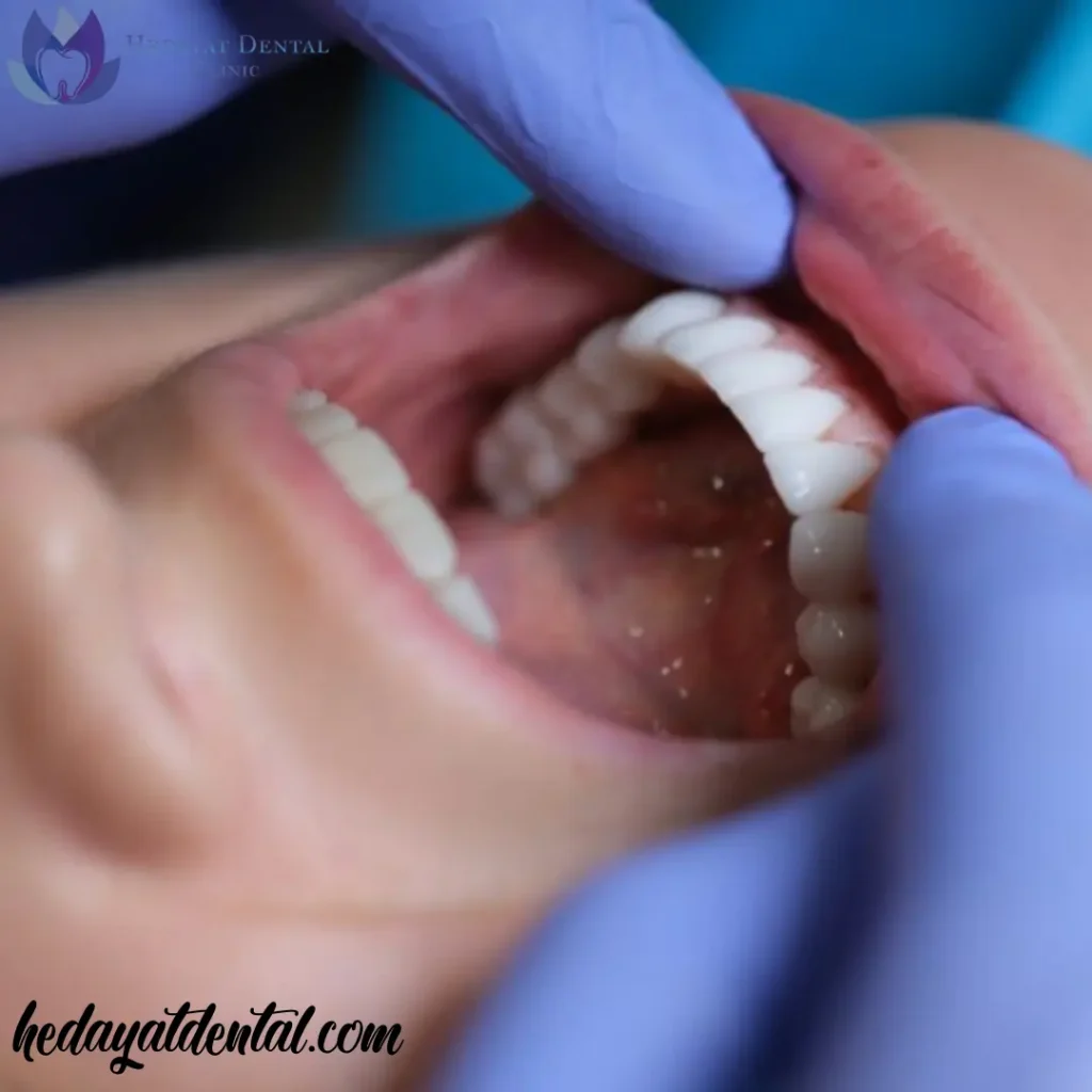 افزایش طول عمر لمینت