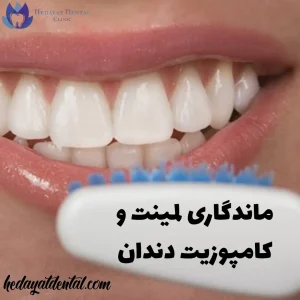 ماندگاری لمینت