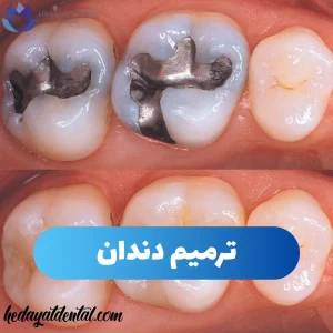 ترمیم دندان