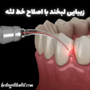 زیبایی لبخند با اصلاح خط لثه