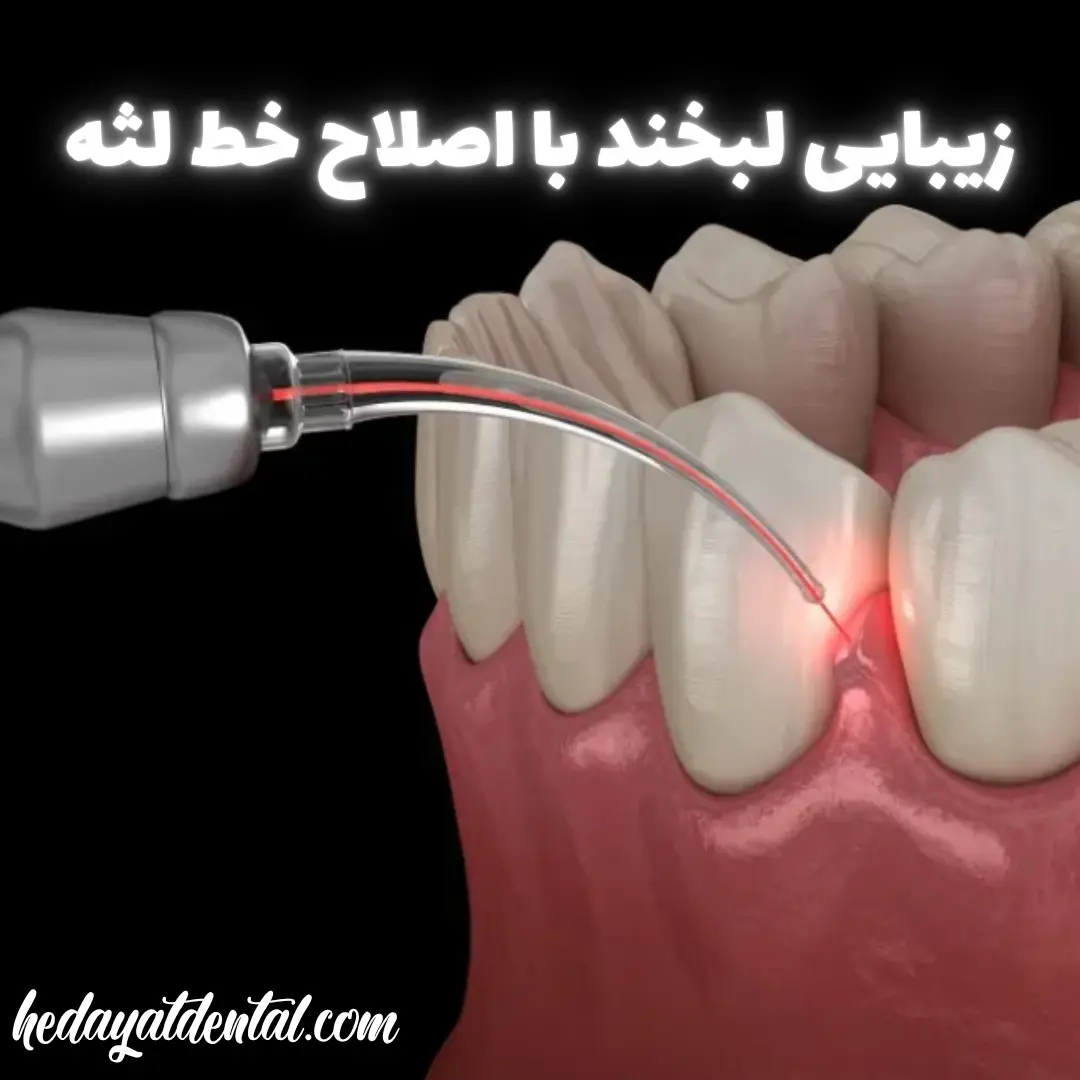 زیبایی لبخند با اصلاح خط لثه